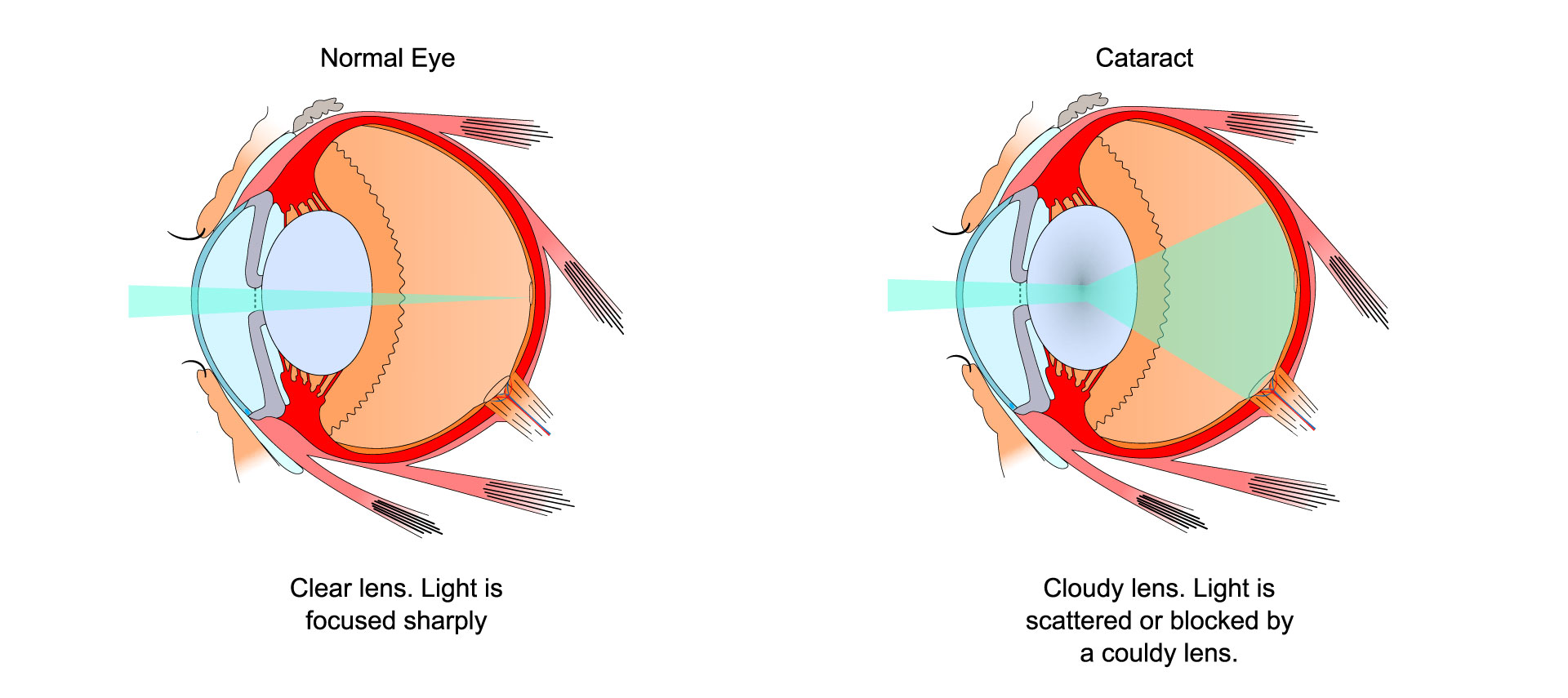 Cataracts