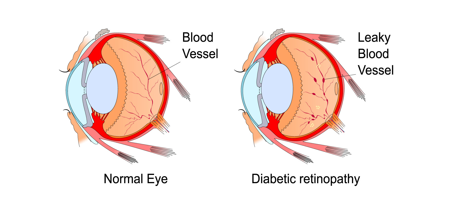 Diabetic retinopathy