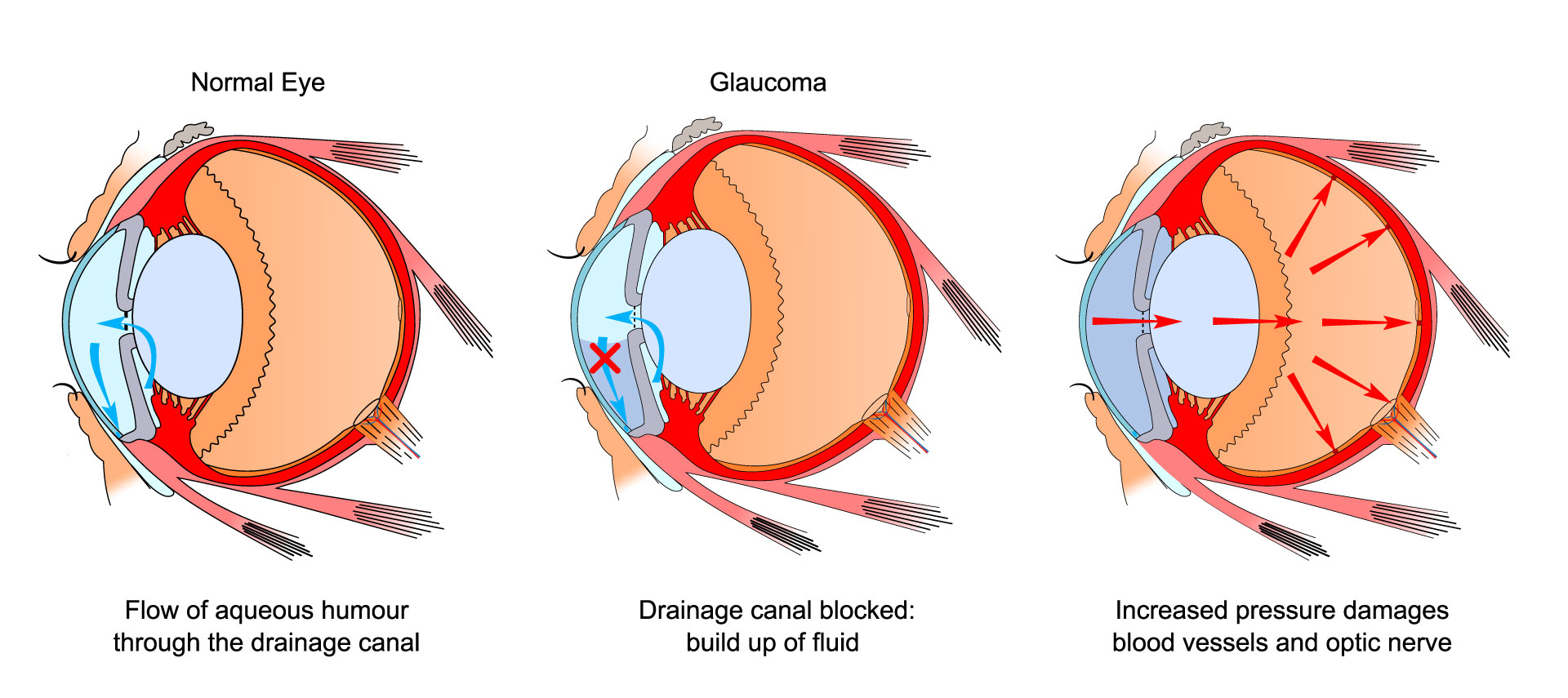 Glaucoma