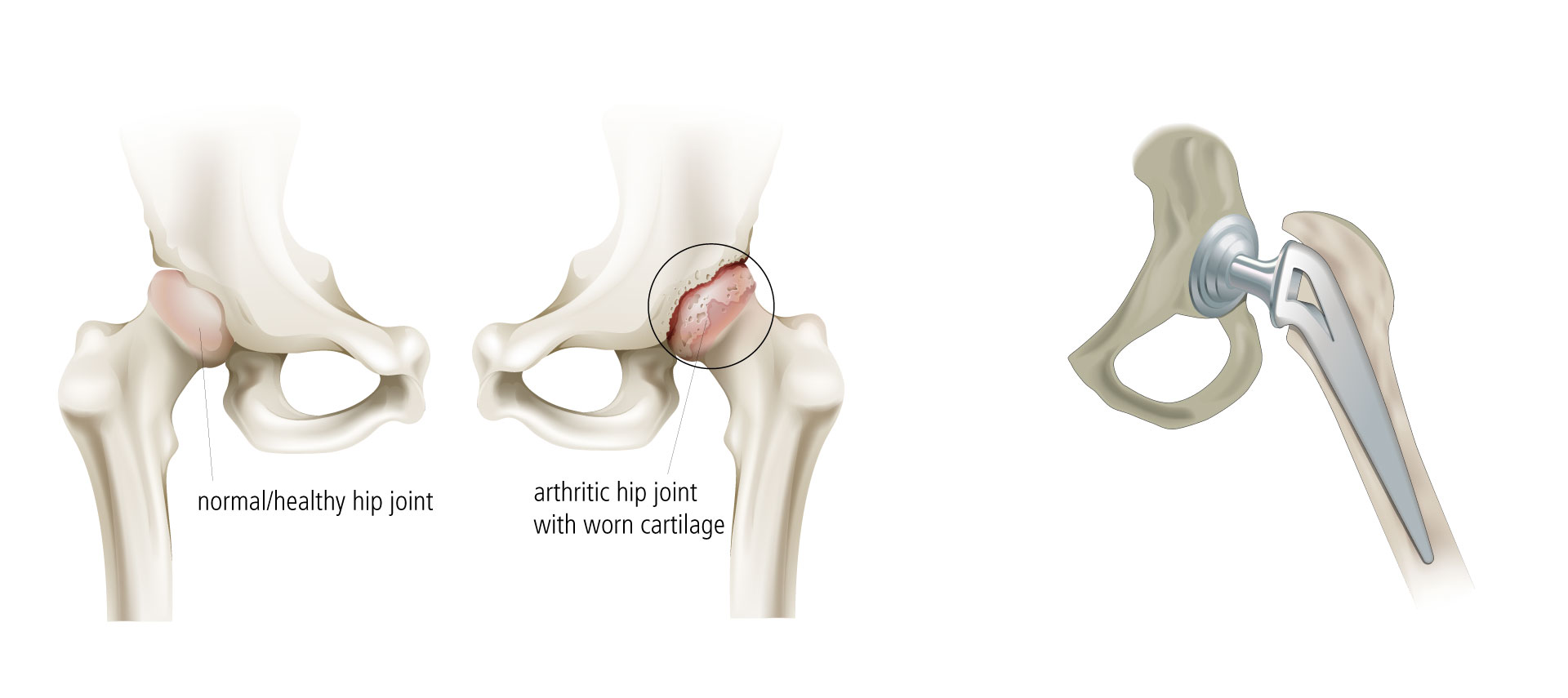 Total hip replacement surgery