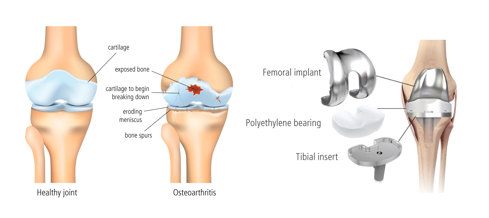 Total knee replacement surgery